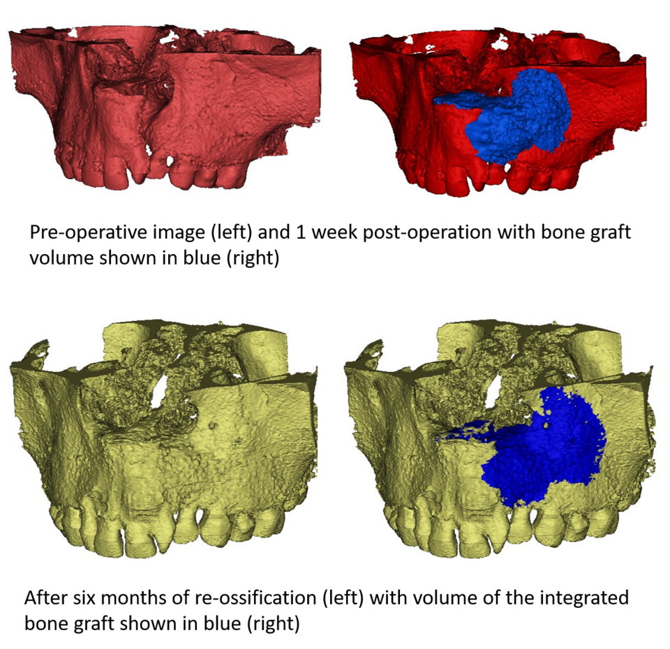 boneGrafting